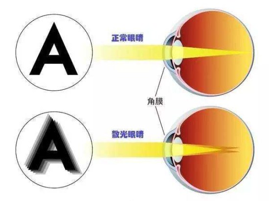 正确选用散光的方法 (正确选用散光隐形眼镜 隐形眼镜散光怎样配)