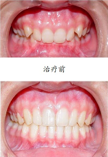 虎牙拔掉了怎样弥补