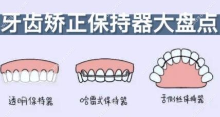 牙齿保持持器是什么