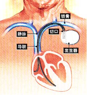 心脏起搏器